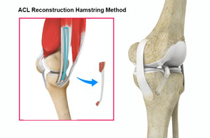 Acl Reconstruction Using Hamstring Tendon